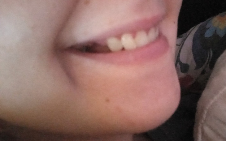 Zbiórka Na proteze zebowa - zdjęcie główne