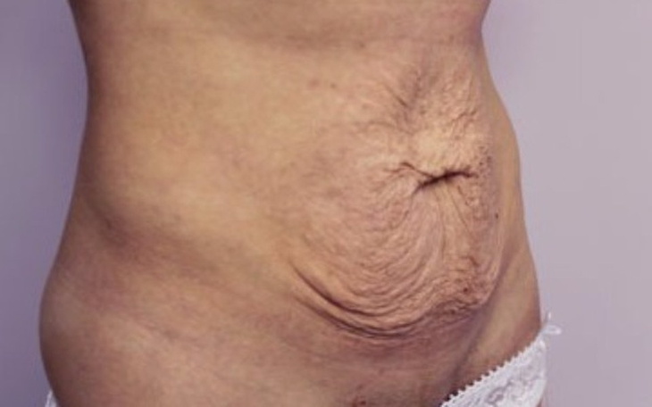 Zbiórka zabieg usunięcia skóry z brzucha - zdjęcie główne