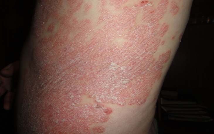 Zbiórka na leczenie łuszczycy. - zdjęcie główne