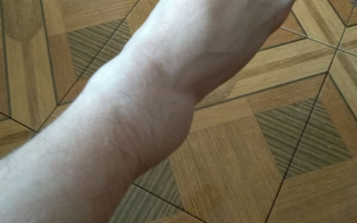 Zbiórka Złamany staw skokowy - zdjęcie główne