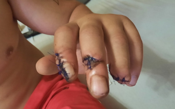 Zbiórka Rekonstrukcja palców - zdjęcie główne