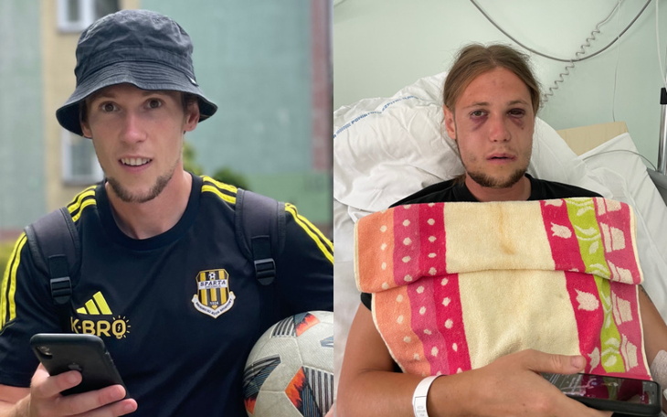 Mężczyzna przed i po wypadku, z widocznymi obrażeniami.