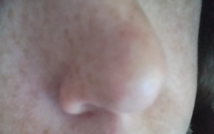 Zbiórka Uraz nosa - zdjęcie główne