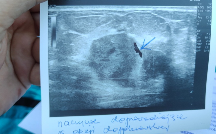 Zbiórka Mam nowotwór na piersi. - zdjęcie główne