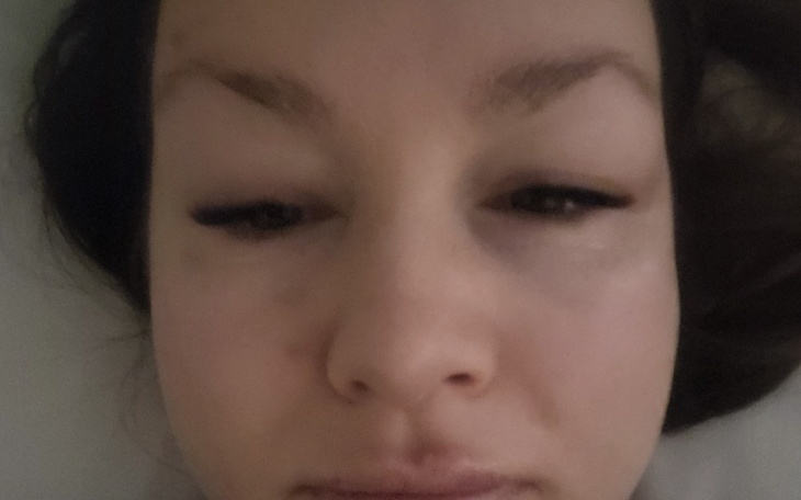 Kobieta z opuchniętymi oczami leży na poduszce.