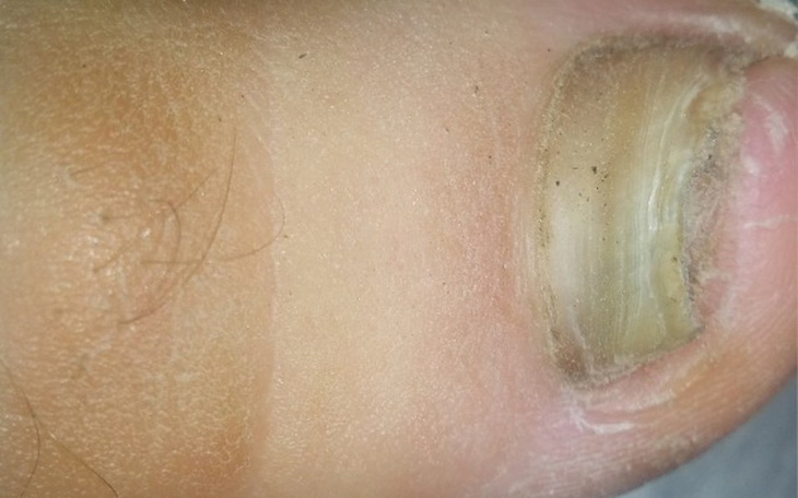 Zbiórka Grzybica paznokci- leczenie - zdjęcie główne