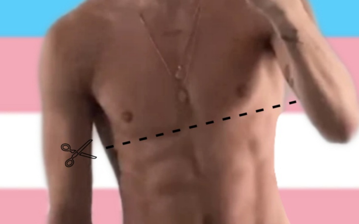 Zbiórka Mastektomia osoby trans. - zdjęcie główne