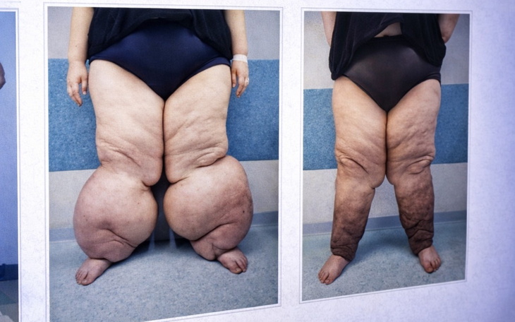 Porównanie nóg przed i po leczeniu.