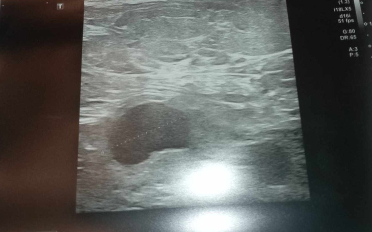 Obraz z badania ultrasonograficznego, widoczna nieprawidłowość.