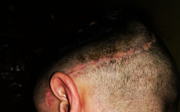 Zbiórka Rekonstrukcja kości czaszki - zdjęcie główne