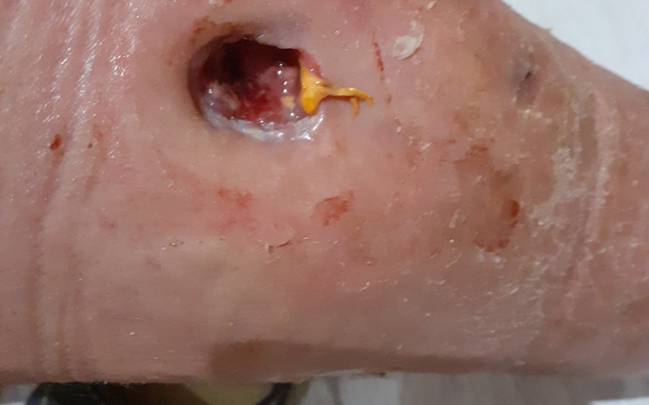 Zbiórka Pomóż Krzysztofowi uratować nogę - zdjęcie główne