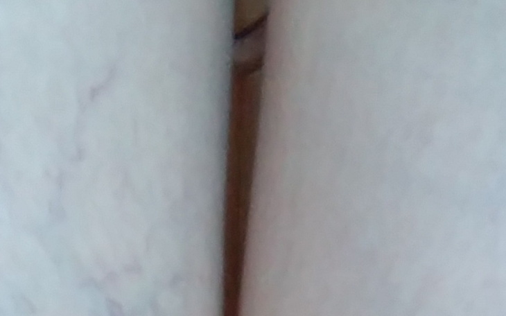 Zbiórka Usunięcia pajeczakow z nóg - zdjęcie główne