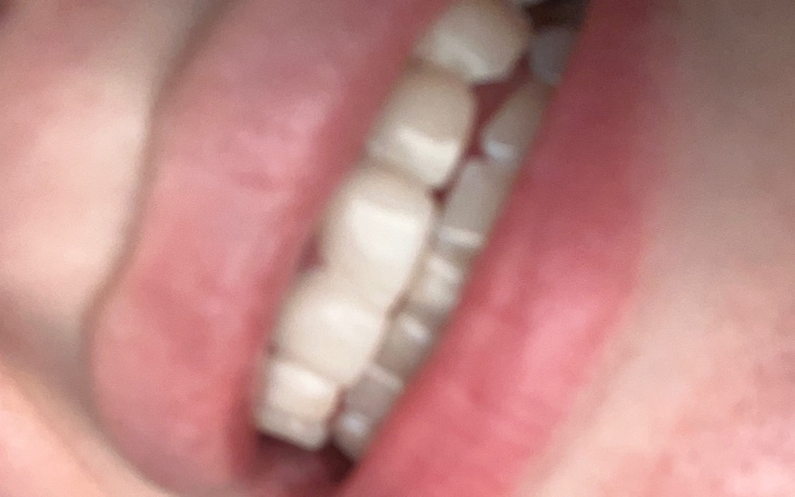 Zbliżenie na usta, z widocznymi zębami.