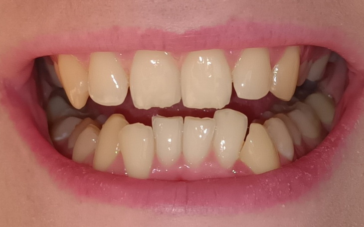 Zbiórka Założenie aparatu na zęby - zdjęcie główne