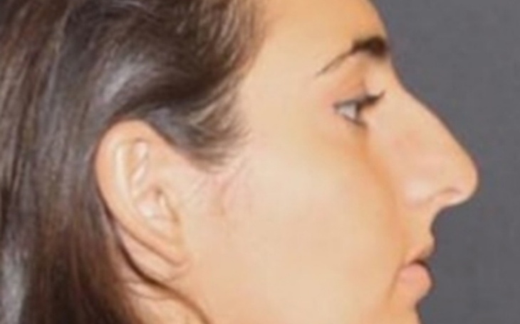 Zbiórka Korekta nosa oraz powiek - zdjęcie główne