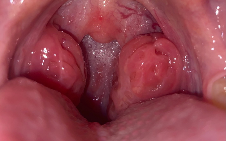 Widok na gardło, z widocznymi migdałkami.