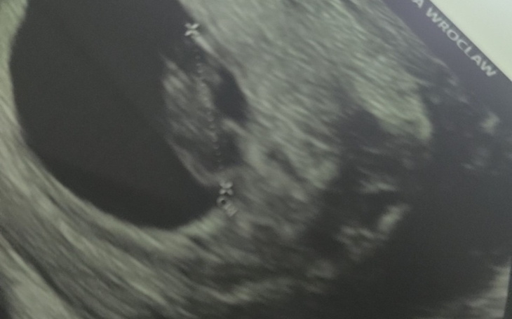Ultrasonografia przedstawiająca obraz wewnętrzny.