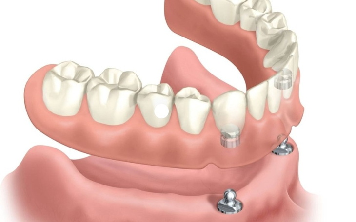 Zbiórka Proteza na implantach góra i dół - zdjęcie główne