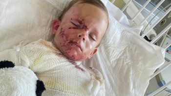 Zbiórka „3-letni Alan ciężko poparzony! Pomóż mu wrócić do zdrowia” - miniaturka zdjęcia