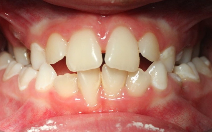 Zbliżenie na zęby z widocznymi przerwami.