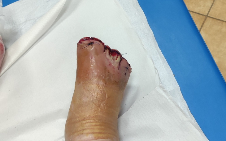 Zraniona stopa po operacji, widok na szwy.