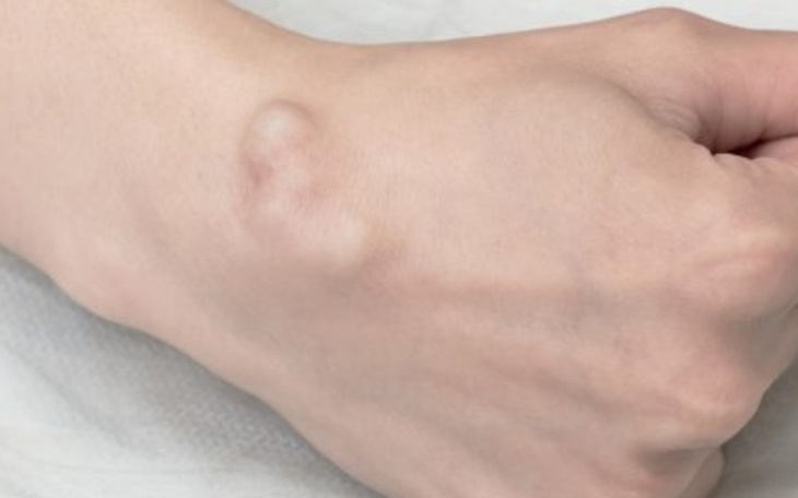 Zbiórka Wycięcie guzków - zdjęcie główne