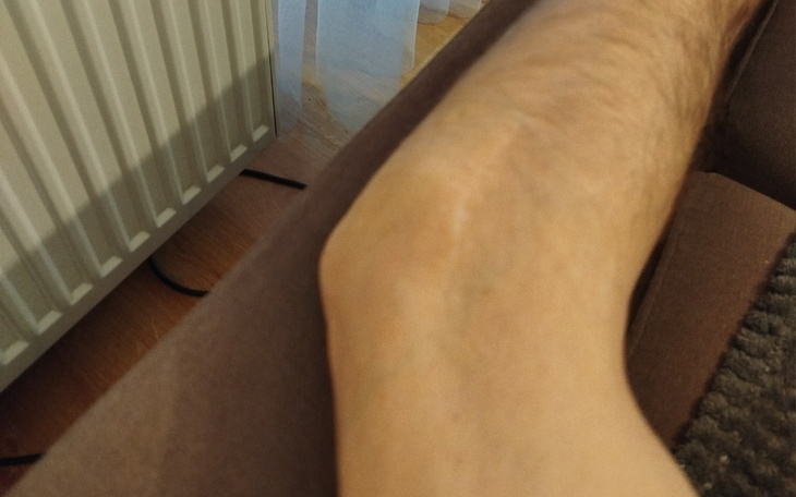 Zbliżenie na nogę z widocznym siniakiem.