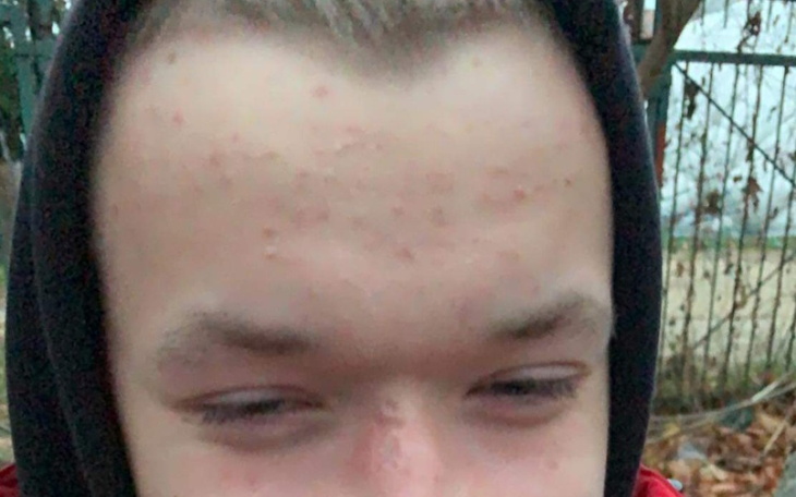 Zbiórka Zbiórka na przeszczep włosów dla - zdjęcie główne