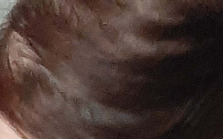 Zbiórka Karboksyterapia wlosy - zdjęcie główne