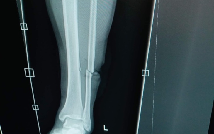 Zbiórka Rehabilitacja mojego brata. - zdjęcie główne