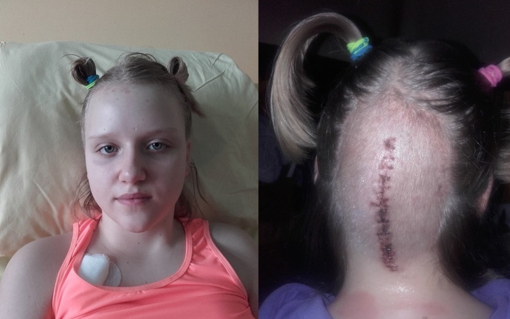 Dziewczyna z widoczną blizną na głowie po operacji, w szpitalnym łóżku.