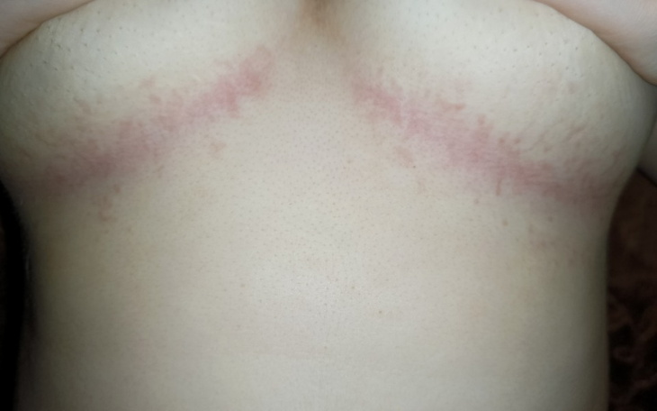 Zbiórka Usunięcie piersi - zdjęcie główne