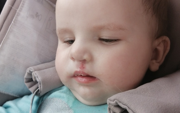 Małe dziecko z raną na nosie, siedzące w foteliku samochodowym.