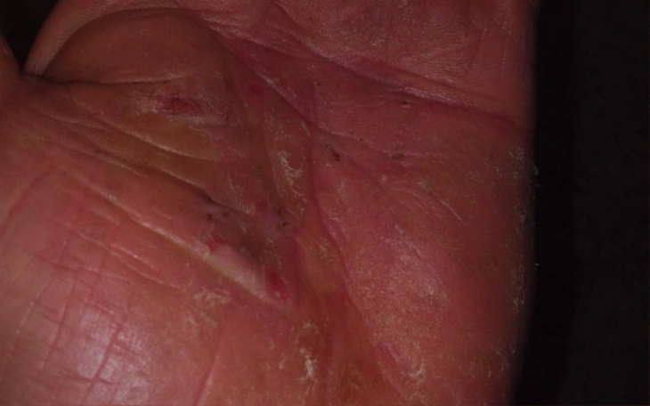 Zbiórka Leczenie nietypowej choroby rąk - zdjęcie główne