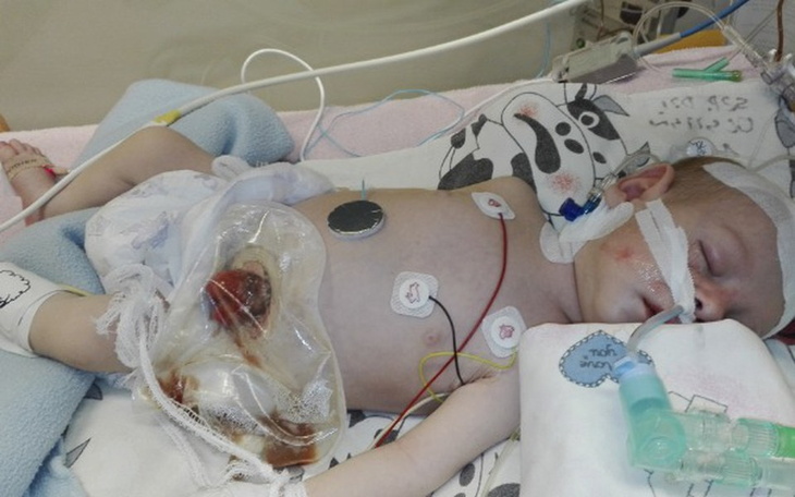 Zbiórka Zapobiec odparzeniom po operacji - zdjęcie główne