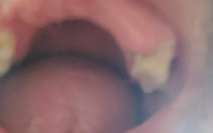 Zbiórka Na implanty zębowe . - zdjęcie główne