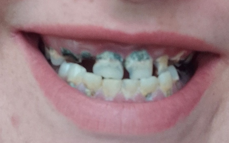 Zbiórka Proteza górna i dolna - zdjęcie główne