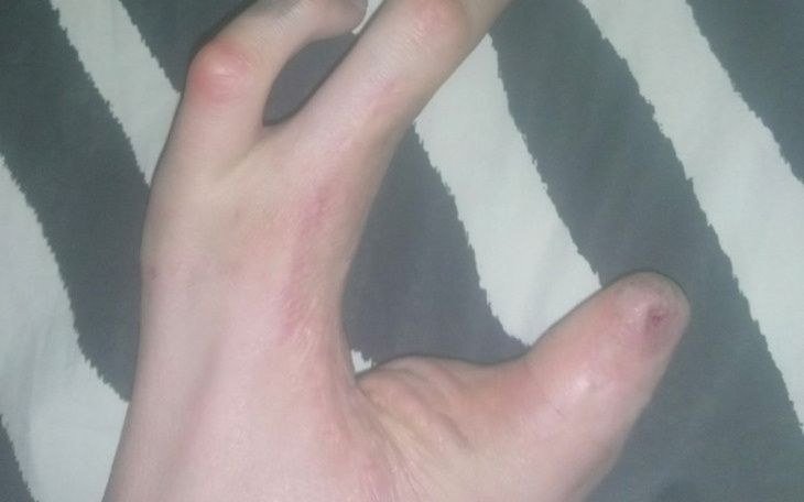 Ręka z deformacją, leżąca na poduszce.