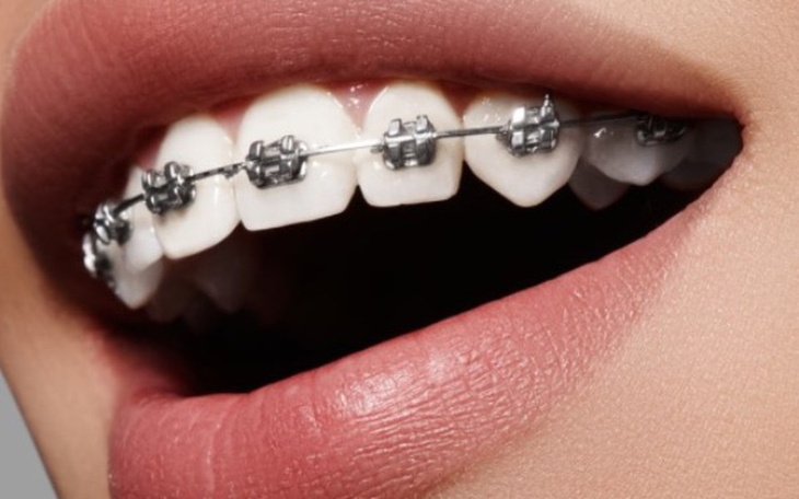 Zbiórka Wada zgryzu~aparat ortodontyczny - zdjęcie główne