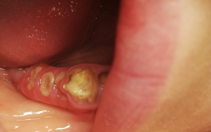 Zbiórka Nadziąślak włóknisty - zdjęcie główne