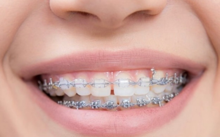 Zbiórka Aparat ortodontyczny,zbieram - zdjęcie główne