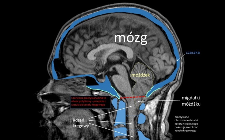 Zbiórka Pomoc z zespołem Chiariego - zdjęcie główne
