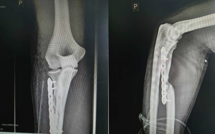 Zdjęcie rentgenowskie kolana z metalowymi elementami.