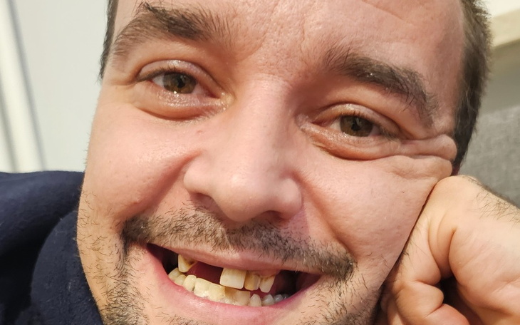 Zbiórka Na wstawienie protezy szkieletow - zdjęcie główne