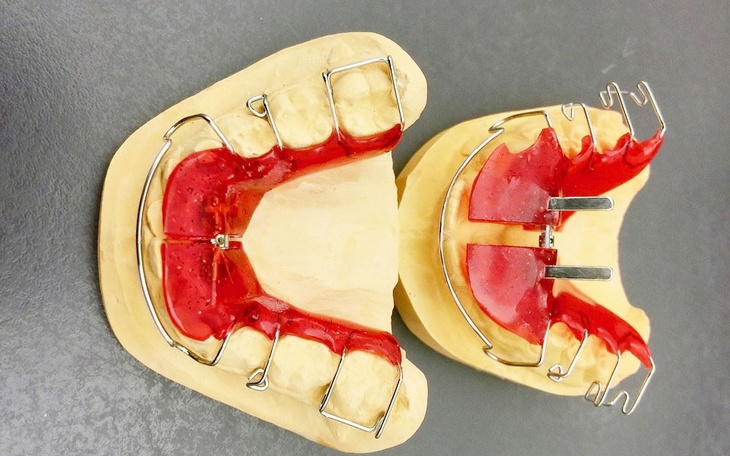 Model zębów z metalowymi elementami ortodontycznymi.