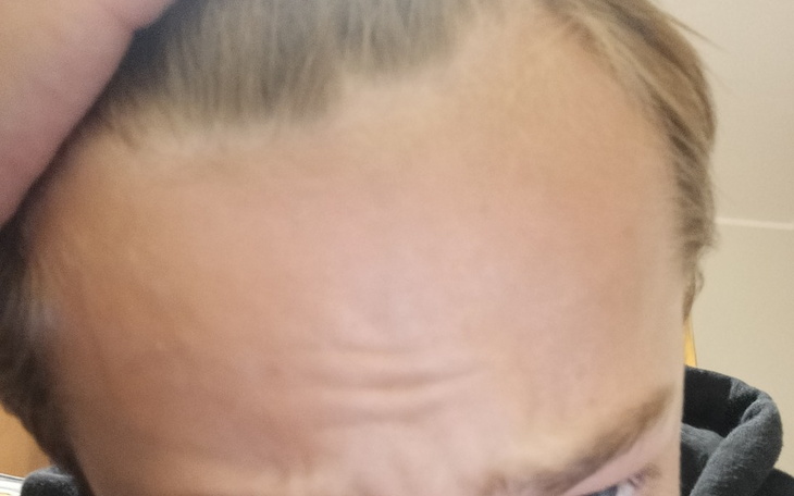 Zbiórka przeszczep włosów blucz - zdjęcie główne