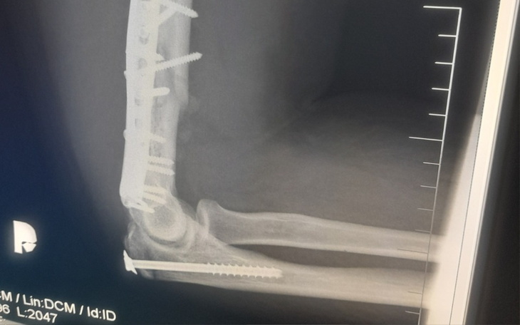 Zbiórka Rehab. ręki po operacji złamania - zdjęcie główne