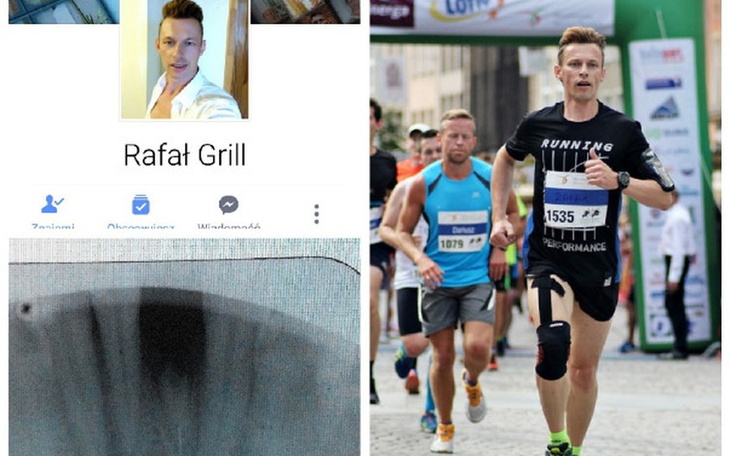 Zbiórka Implant zęba dla biegacza - zdjęcie główne