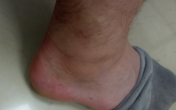 Zbiórka Operacje stawu skokowego - zdjęcie główne