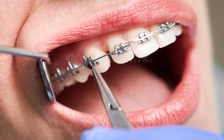 Zbiórka Zbiórka na aparat ortodontycznyy - zdjęcie główne